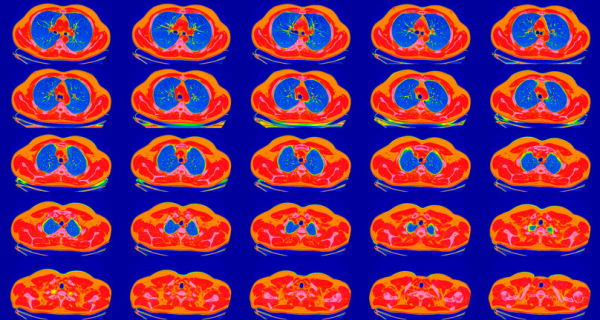 CT scan showing multiple crosss-sections of a lung in shades of red, blue, and yellow on a purple background 